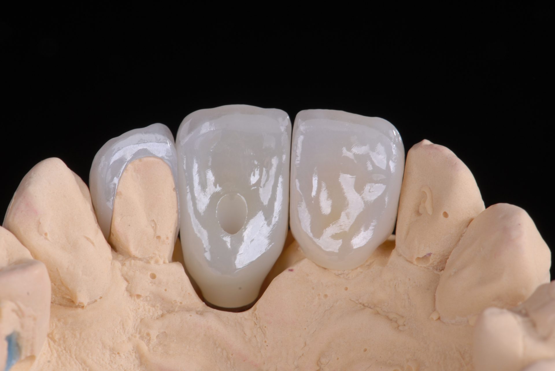 Dentallabor Implantate