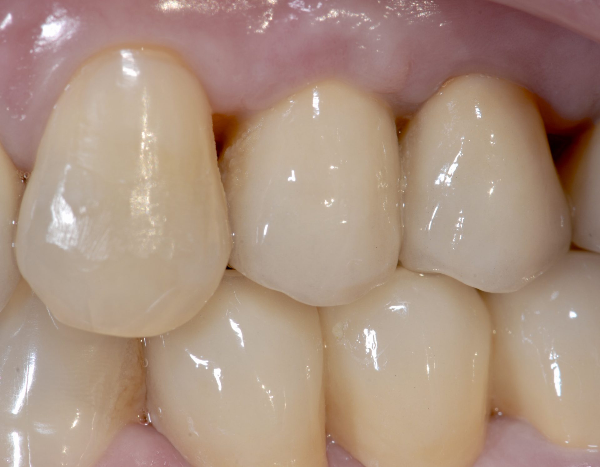 Fertige Kronen auf Implantat und natürlichen Zähnen
